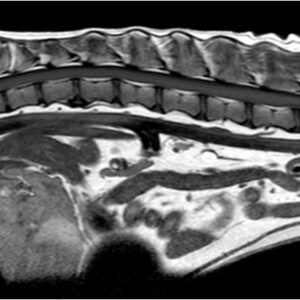 Tethered cord syndrome